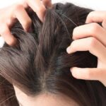 Penyebab munculnya jerawat di kulit kepala dan cara mengobatinya