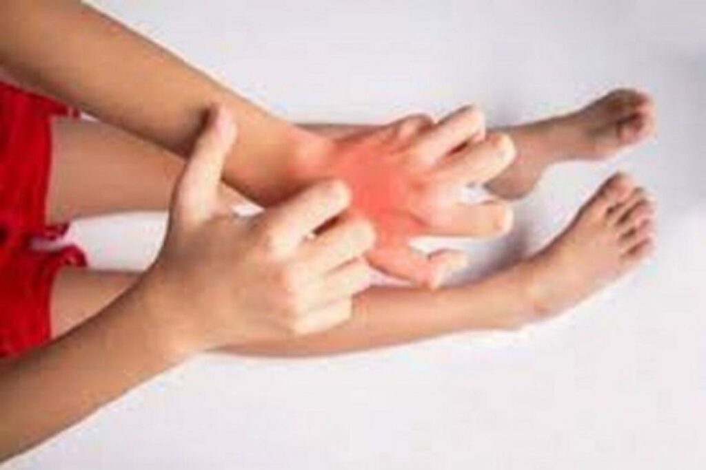 Tak sengaja makan udang? Ini pertolongan pertamanya jika alergi kambuh